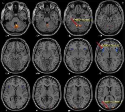 Disrupted interhemispheric coordination of sensory-motor networks and insula in major depressive disorder